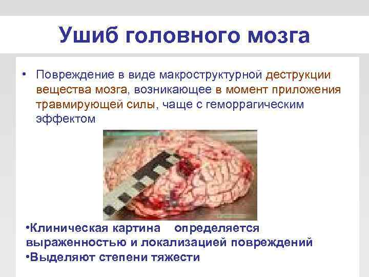  Ушиб головного мозга • Повреждение в виде макроструктурной деструкции  вещества мозга, возникающее