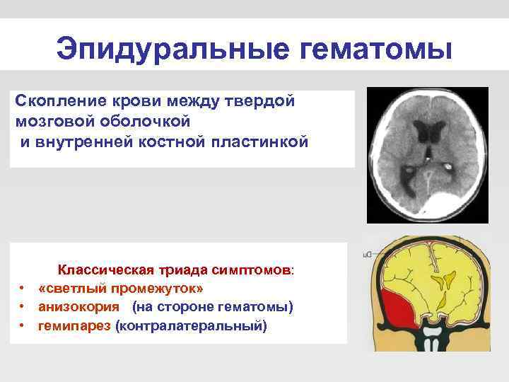   Эпидуральные гематомы Скопление крови между твердой мозговой оболочкой и внутренней костной пластинкой