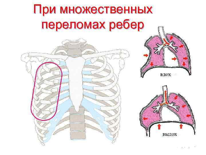 При множественных переломах ребер 