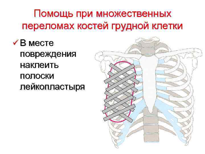  Помощь при множественных переломах костей грудной клетки ü В месте повреждения наклеить полоски