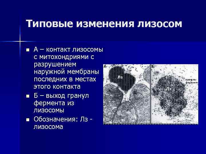 Типовые изменения лизосом n А – контакт лизосомы с митохондриями с разрушением наружной мембраны