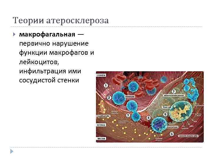 Теории атеросклероза макрофагальная — первично нарушение функции макрофагов и лейкоцитов, инфильтрация ими сосудистой стенки