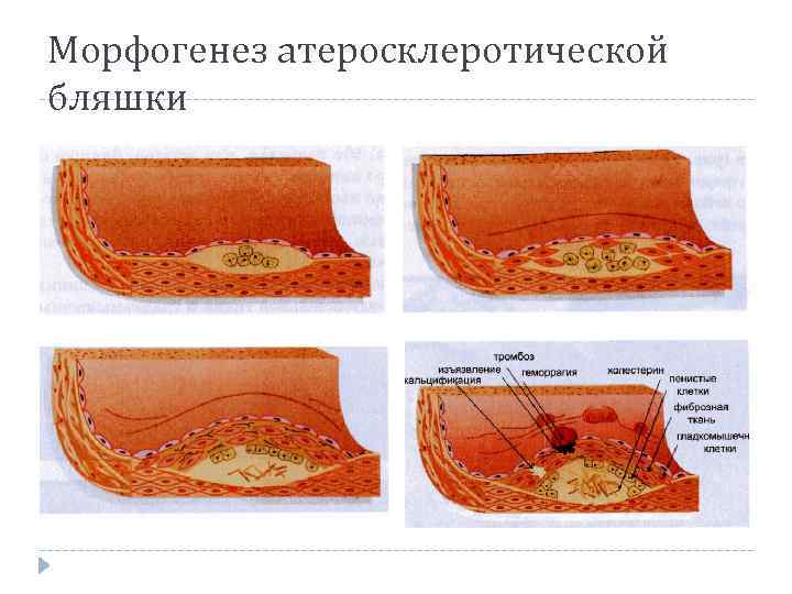 Морфогенез атеросклеротической бляшки 