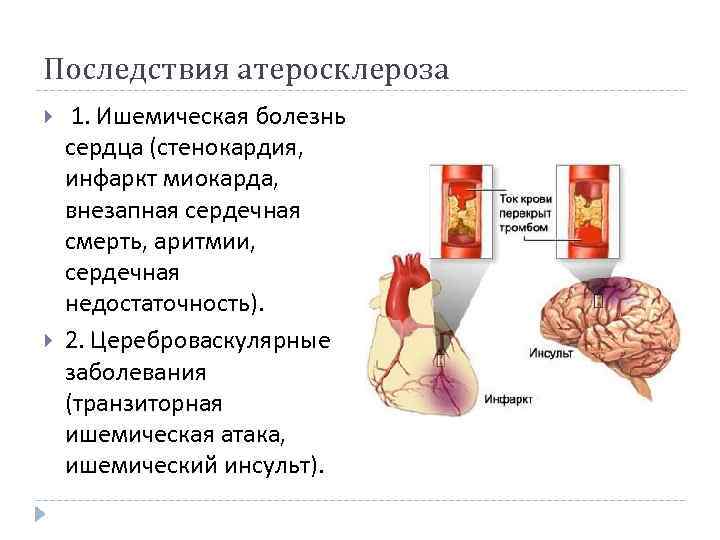 Последствия атеросклероза 1. Ишемическая болезнь сердца (стенокардия, инфаркт миокарда, внезапная сердечная смерть, аритмии, сердечная