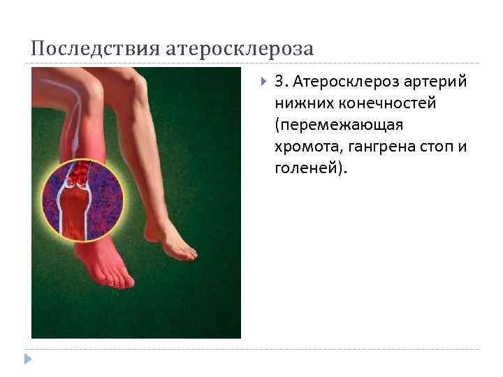 Последствия атеросклероза 3. Атеросклероз артерий нижних конечностей (перемежающая хромота, гангрена стоп и голеней). 