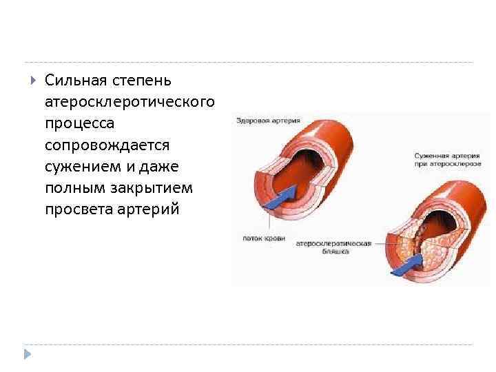  Сильная степень атеросклеротического процесса сопровождается сужением и даже полным закрытием просвета артерий 