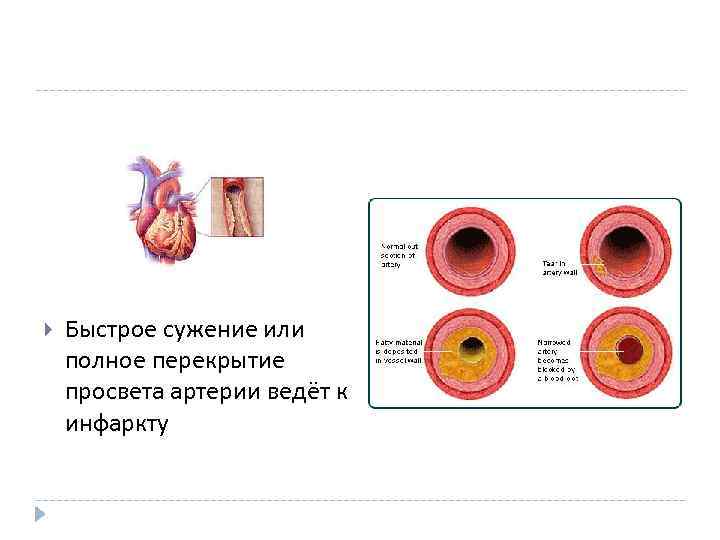  Быстрое сужение или полное перекрытие просвета артерии ведёт к инфаркту 