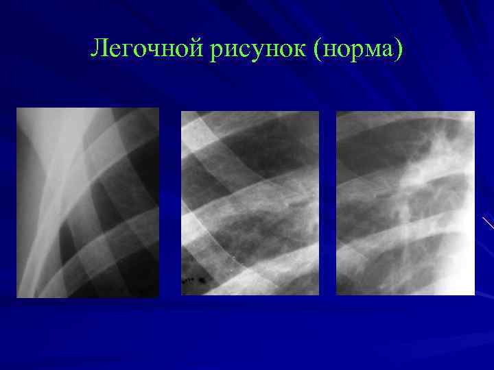 Деформация легочного рисунка что это