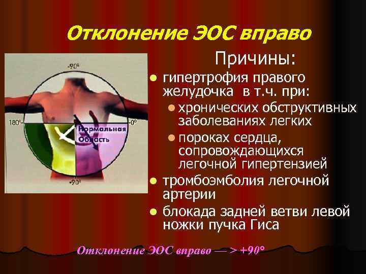 Ось вправо. Отклонение электрической оси вправо на ЭКГ. Отклонение ЭОС вправо причины. Отклонение оси сердца вправо на ЭКГ. Электрическая ось отклонена вправо.