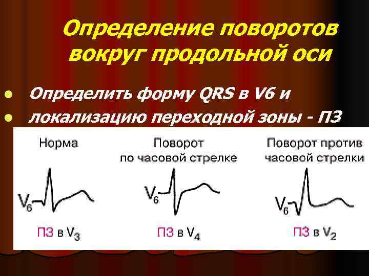   Определение поворотов   вокруг продольной оси l  Определить форму QRS