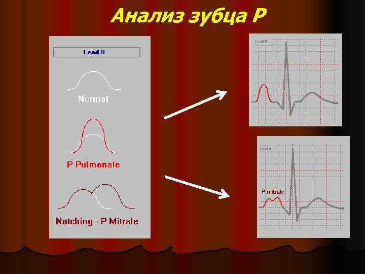 Анализ зубца Р 