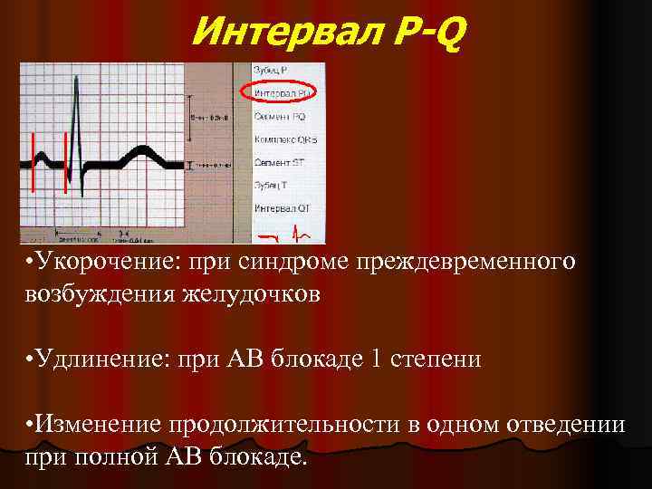   Интервал P-Q  • Укорочение: при синдроме преждевременного возбуждения желудочков  •