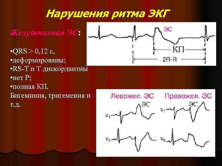 Нарушение ритма по типу бигеминии карта вызова