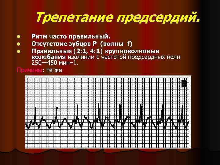 Ритм 1 2. Трепетание предсердий 2 к 1 на ЭКГ. Трепетание 1 к 1 на ЭКГ. Трепетание предсердий 1 к 1 на ЭКГ. Ритмированная форма трепетания предсердий.