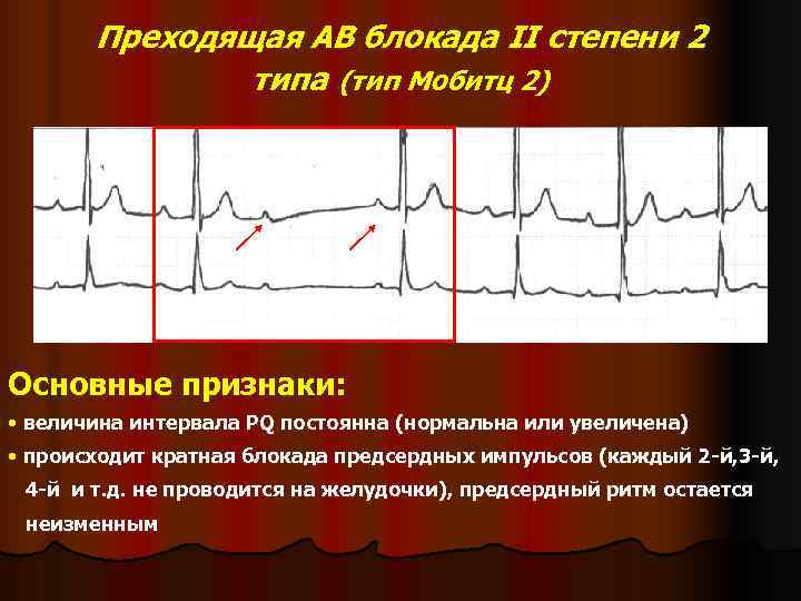 Блокада сердца опасно для жизни. Диагноз АВ блокада 2 степени. АВ блокада 2 степени 3 Тип. АВ блокада 2 типа транзиторная блокада степени 1. АВ блокада 2 степени Мобитц 1 на ЭКГ.