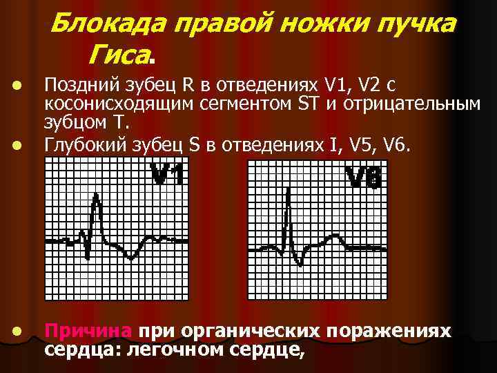 Блокада правой ножки. Глубокий зубец s в v1 v2. Блокада правой ножки Гиса v1 v2. Блокада правой ножки пучка зубец р. Блокада пучка Гиса v1.