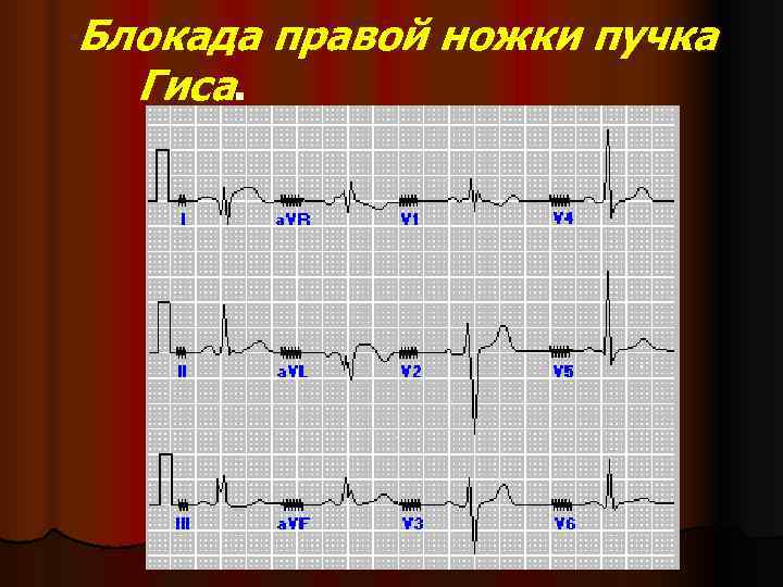  Блокада правой ножки пучка Гиса.  