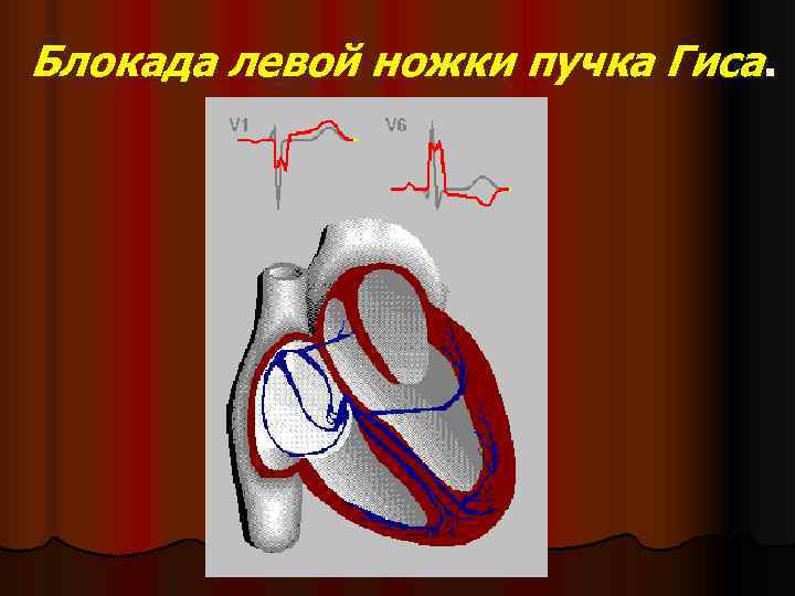  Блокада левой ножки пучка Гиса.  