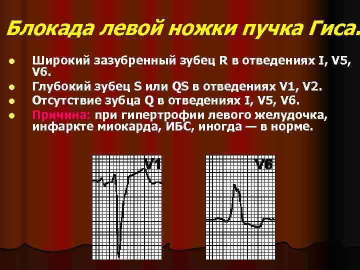 Блокада левой ножки пучка Гиса. l  Широкий зазубренный зубец R в отведениях I,