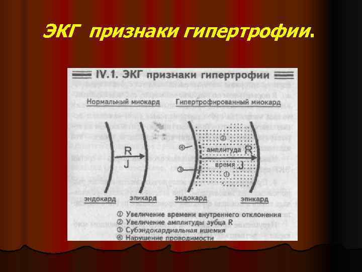 ЭКГ признаки гипертрофии.  