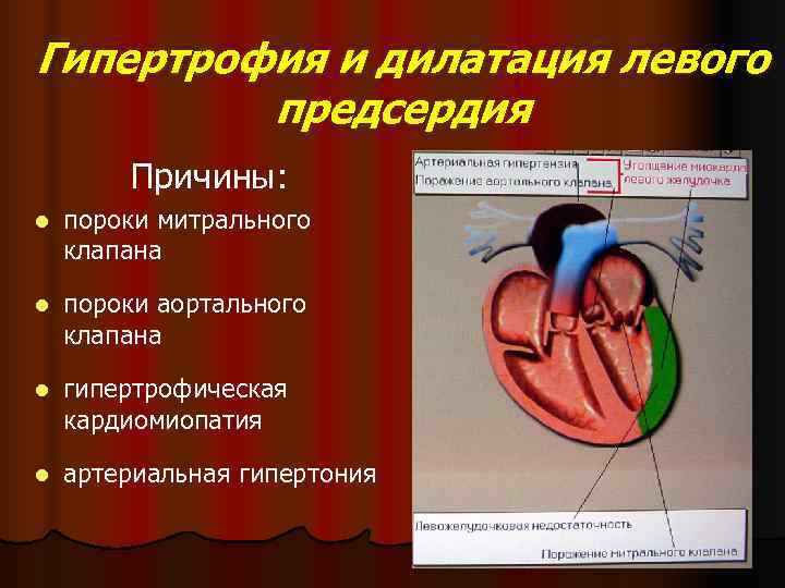 Дилатация левого предсердия степени. Дилатация левого предсердия причины. Дилатация левого желудочка причины. Дилатация правого желудочка причины. Незначительная дилатация левого предсердия что это такое.