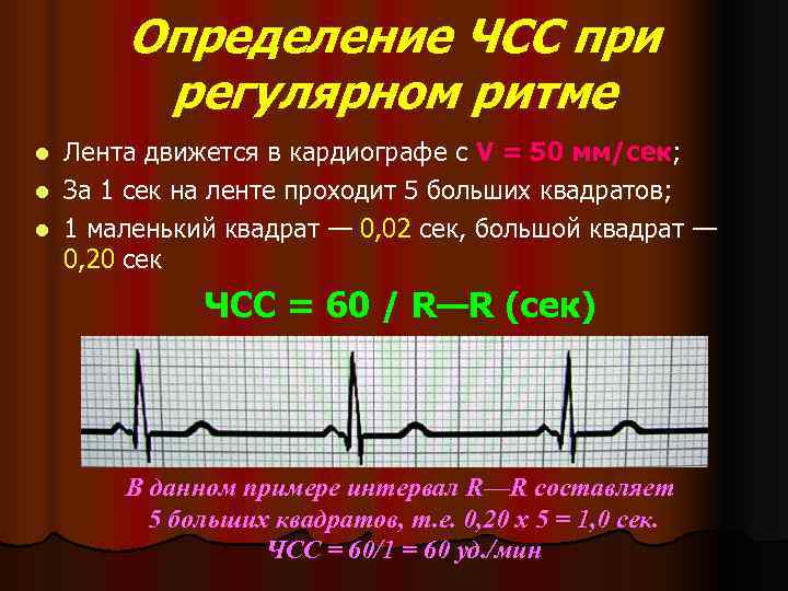   Определение ЧСС при   регулярном ритме l Лента движется в кардиографе
