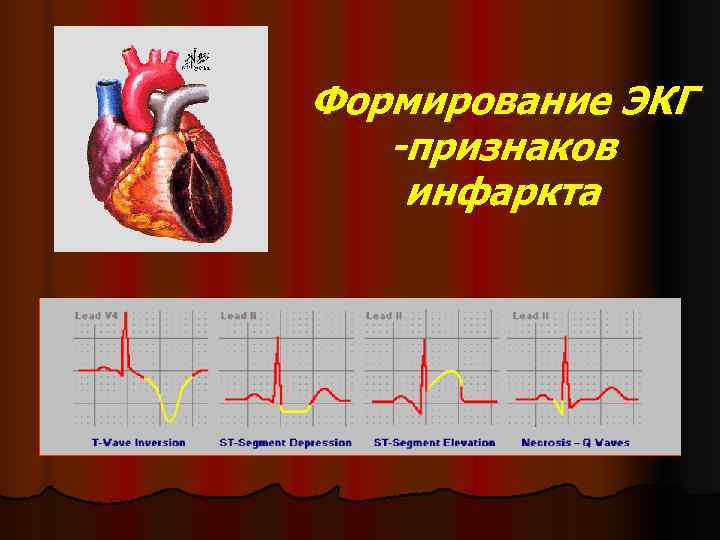 Формирование ЭКГ  -признаков  инфаркта 