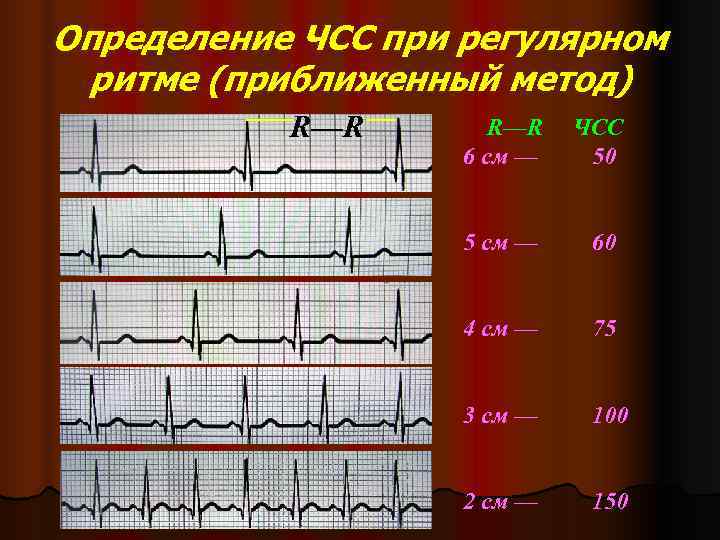 Определение ЧСС при регулярном  ритме (приближенный метод)  R—R  ЧСС  