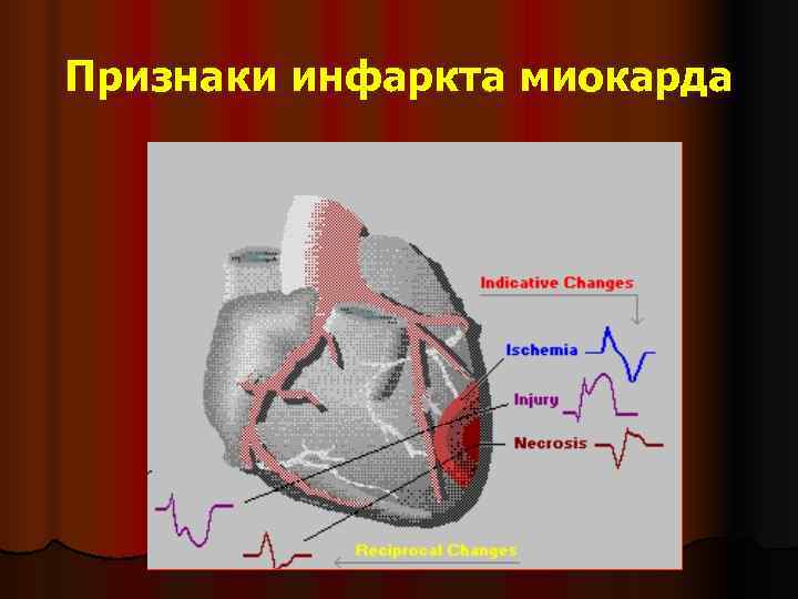 Признаки инфаркта миокарда 