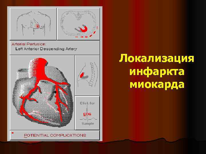 Локализация  инфаркта  миокарда 
