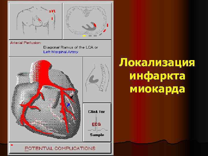 Локализация  инфаркта  миокарда 