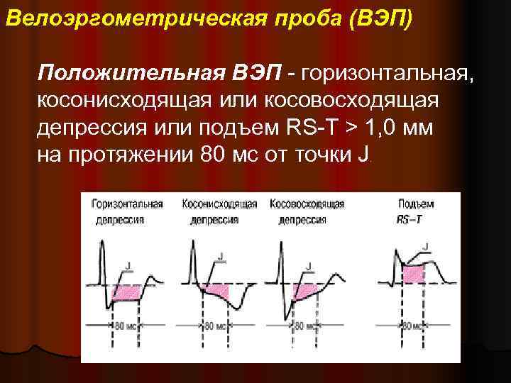 Велоэргометрическая проба (ВЭП)  Положительная ВЭП - горизонтальная,  косонисходящая или косовосходящая  депрессия