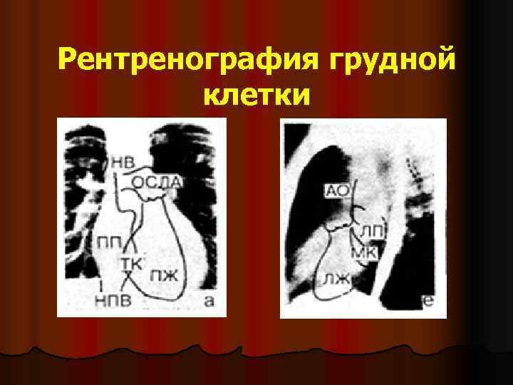 Рентренография грудной   клетки 