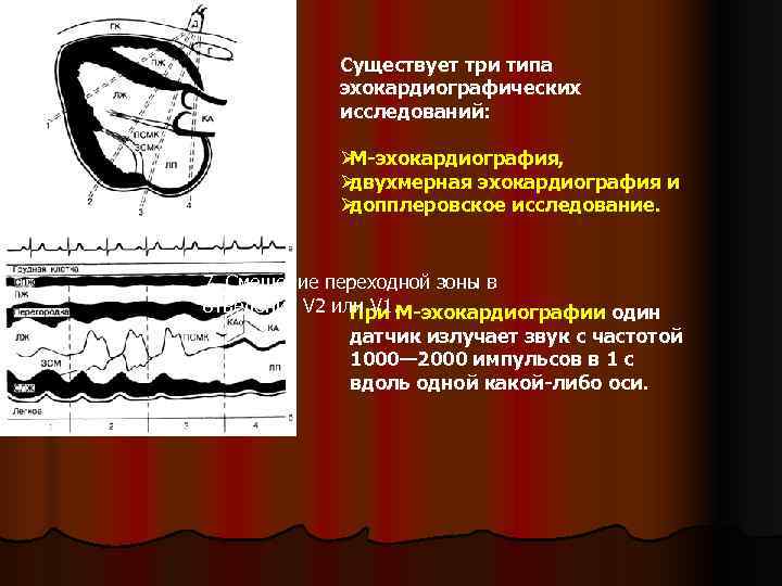   Существует три типа   эхокардиографических   исследований:   