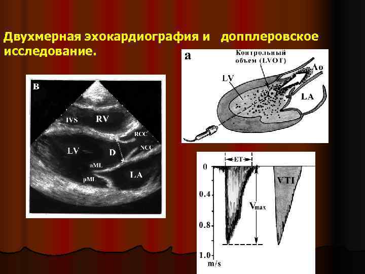 Эхокардиография что это за обследование. Эхокардиография принцип. Двухмерная эхокардиография. Одномерная эхокардиография. Двухмерная эхокардиография (в - режим).