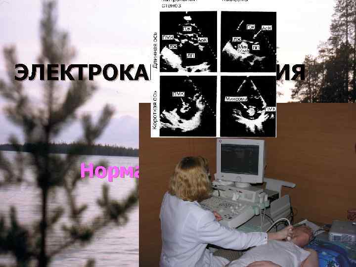  ОЦЕНКА РАЗМЕРОВ ОБШИРНОЙ АНЕВРИЗМЫ ЛЖ С ПОМОЩЬЮ  РАДИОНУКЛИДНЫХ ИЗОБРАЖЕНИЙ МИОКАРДА  