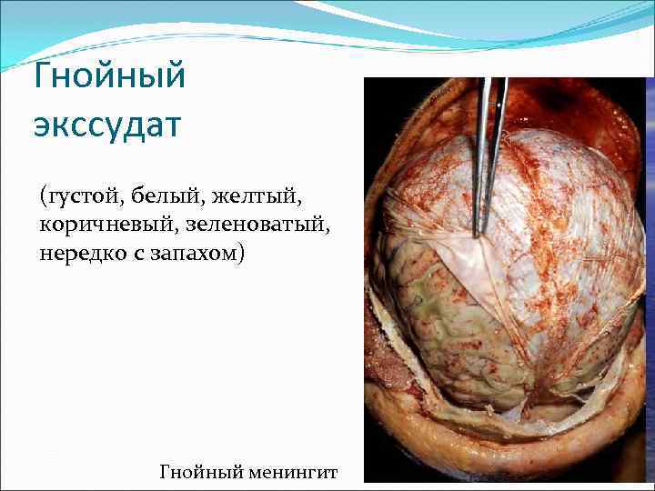 Гнойный экссудат (густой, белый, желтый, коричневый, зеленоватый, нередко с запахом) Гнойный менингит 