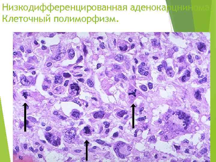 Низкодифференцированная аденокарцнинома. Клеточный полиморфизм. 