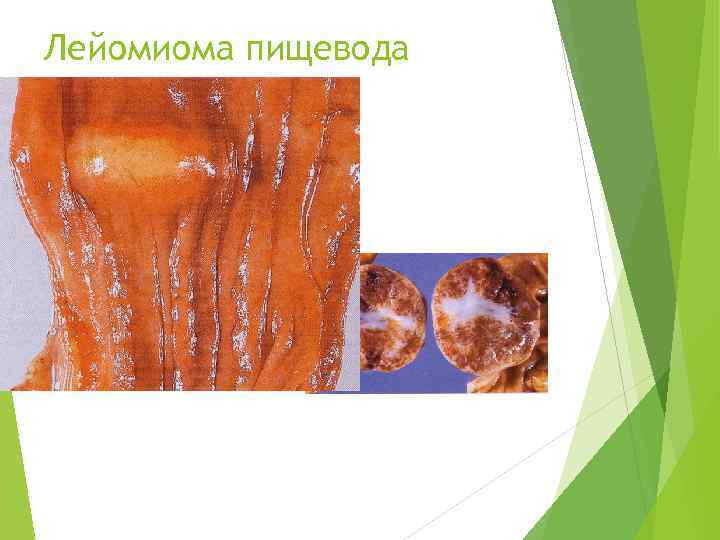 Лейомиома пищевода 