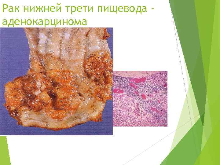 Рак нижней трети пищевода - аденокарцинома 