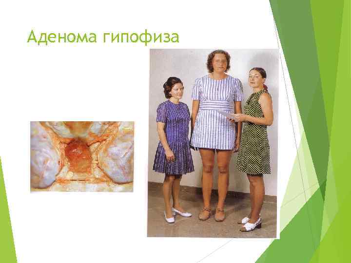 Аденома гипофиза 