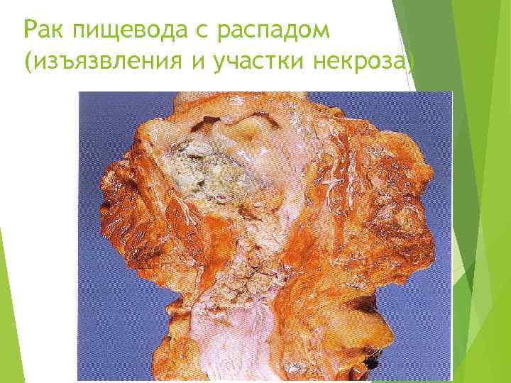 Рак пищевода с распадом (изъязвления и участки некроза) 