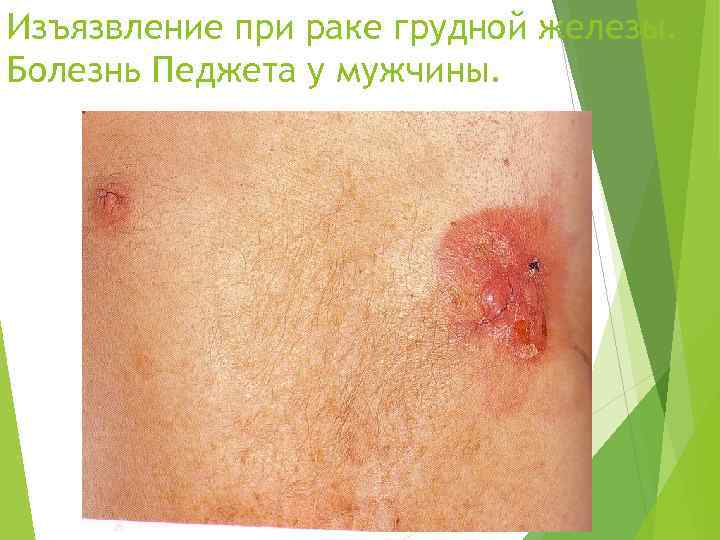 Изъязвление при раке грудной железы. Болезнь Педжета у мужчины. 