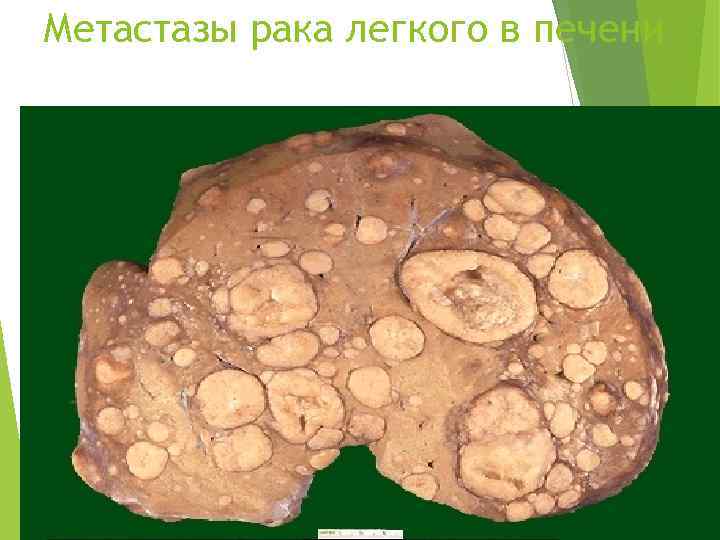 Метастазы рака легкого в печени 