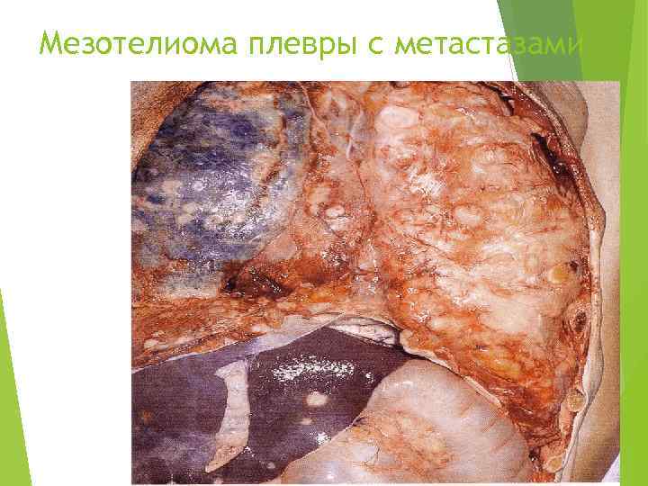Мезотелиома плевры с метастазами 
