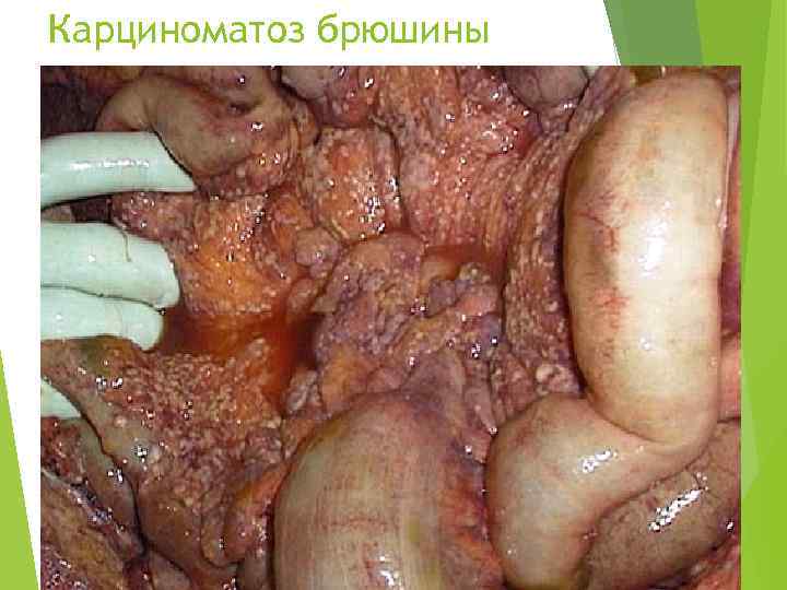 Карциноматоз брюшины 