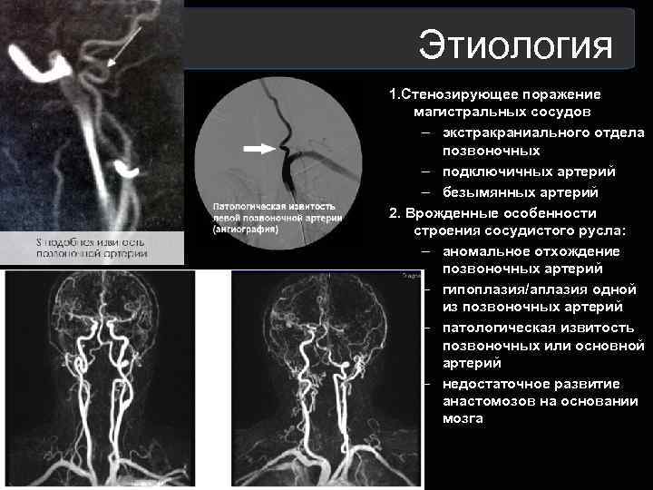  Этиология 1. Стенозирующее поражение магистральных сосудов – экстракраниального отдела позвоночных – подключичных артерий