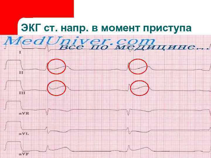 ЭКГ ст. напр. в момент приступа 