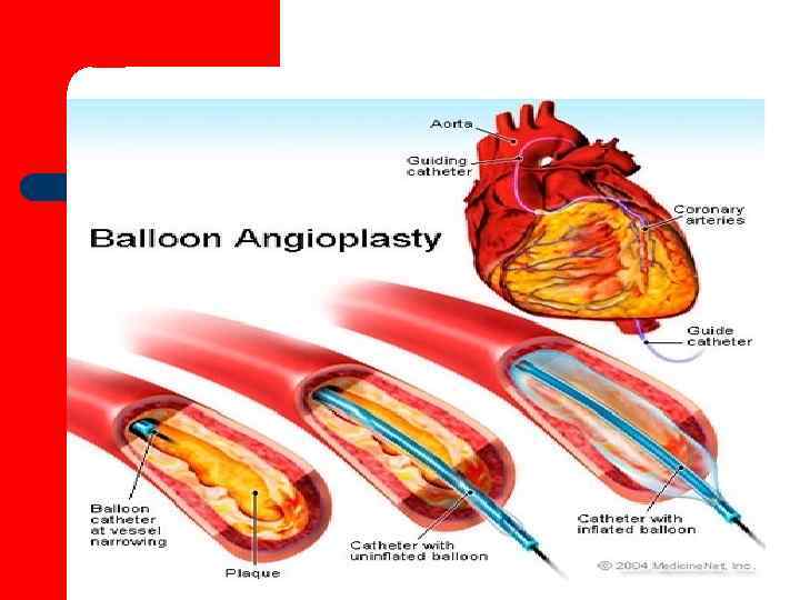 восстановления коронарного кровотока 