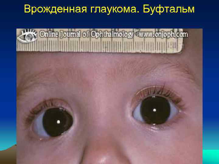 Врожденная глаукома 